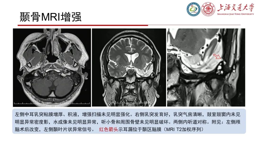 【病例】脑脊液耳漏1例CT及MR病例讨论-7