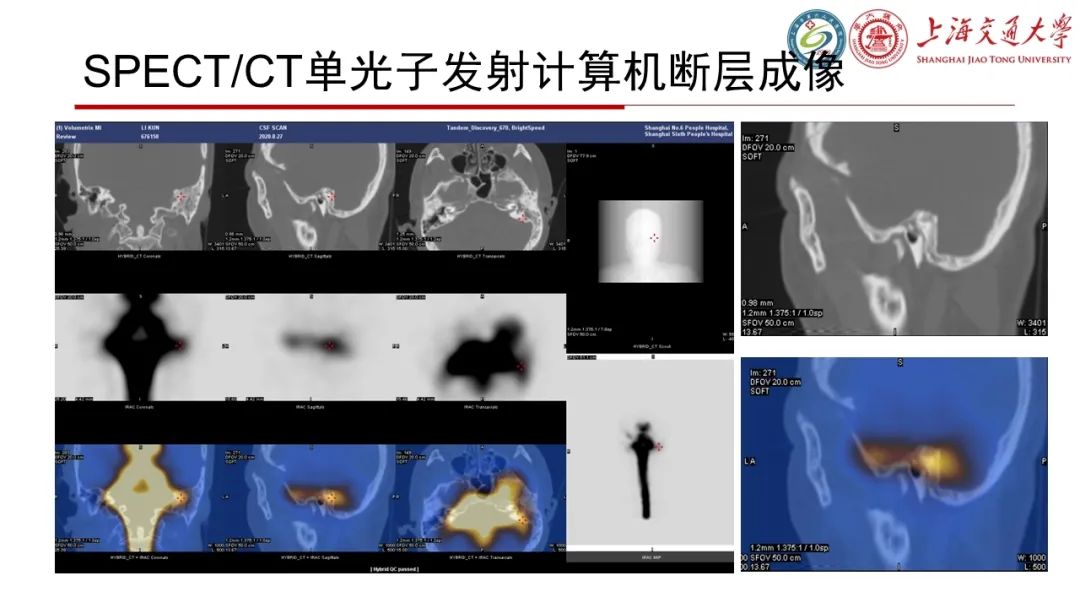 【病例】脑脊液耳漏1例CT及MR病例讨论-8