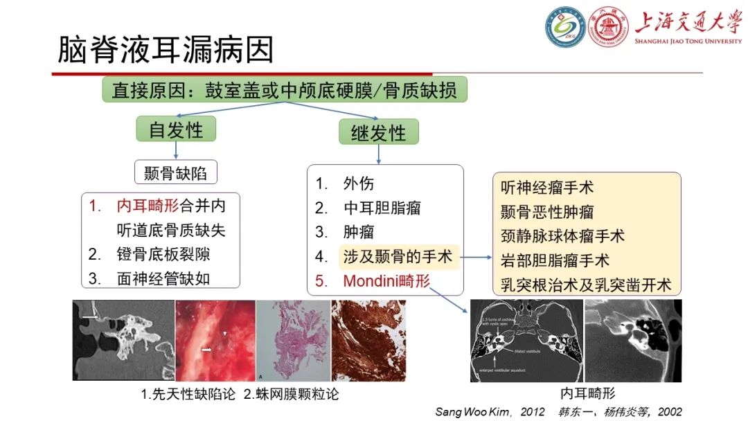 【病例】脑脊液耳漏1例CT及MR病例讨论-15
