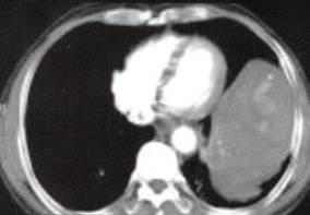 【病例】胸膜孤立性纤维瘤1例