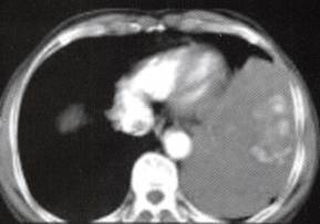 【病例】胸膜孤立性纤维瘤1例