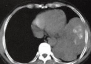 【病例】胸膜孤立性纤维瘤1例