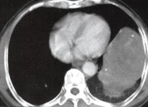 【病例】胸膜孤立性纤维瘤1例