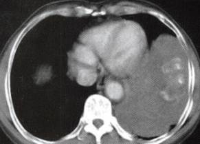 【病例】胸膜孤立性纤维瘤1例