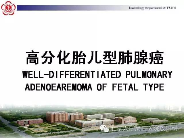 【病例】高分化胎儿型肺腺瘤1例CT