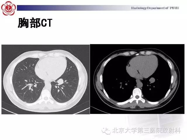 【病例】高分化胎儿型肺腺瘤1例CT