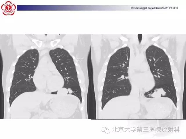 【病例】高分化胎儿型肺腺瘤1例CT