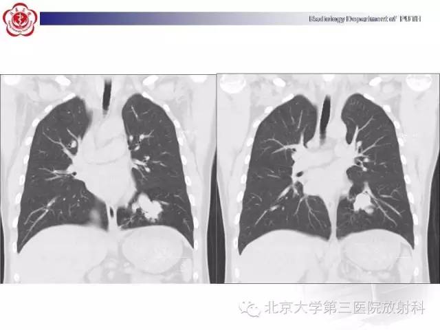 【病例】高分化胎儿型肺腺瘤1例CT