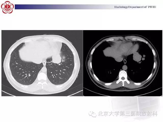 【病例】高分化胎儿型肺腺瘤1例CT