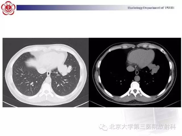 【病例】高分化胎儿型肺腺瘤1例CT