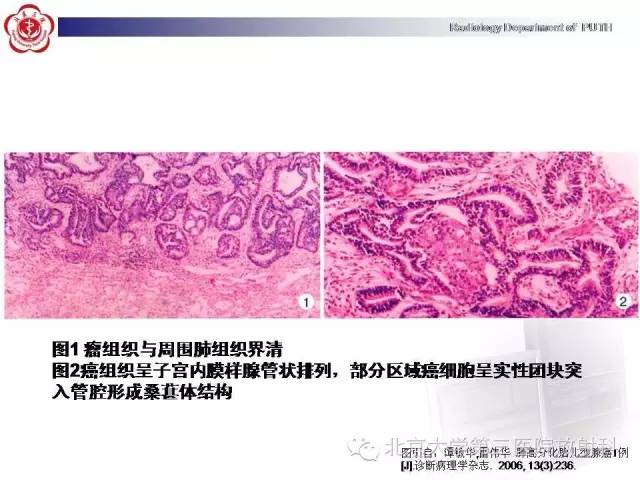【病例】高分化胎儿型肺腺瘤1例CT