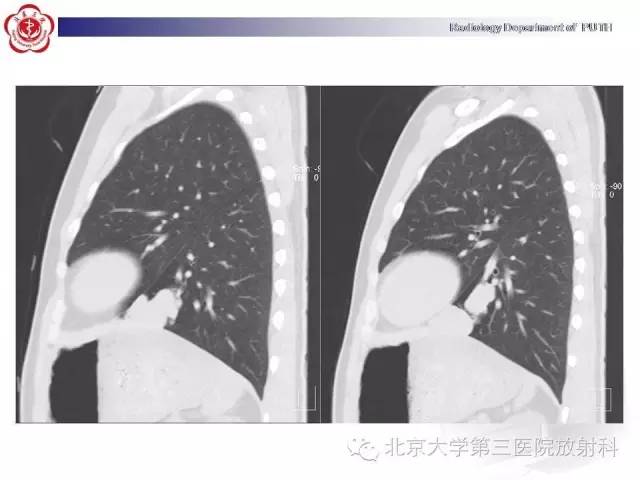 【病例】高分化胎儿型肺腺瘤1例CT