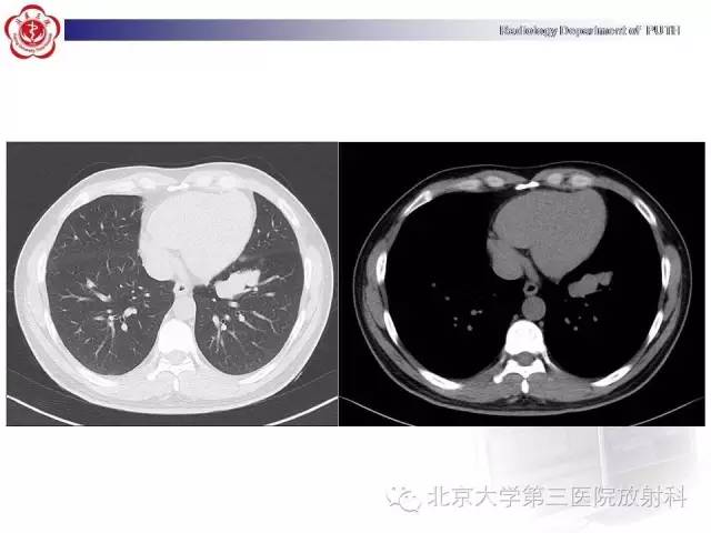 【病例】高分化胎儿型肺腺瘤1例CT