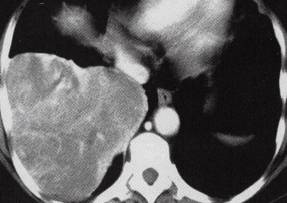 【病例】胸膜孤立性纤维瘤1例CT影像表现