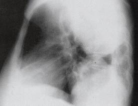 【病例】胸膜孤立性纤维瘤1例CT影像表现