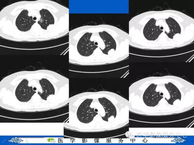 【病例】胸膜孤立性纤维瘤1例CT影像表现与鉴别