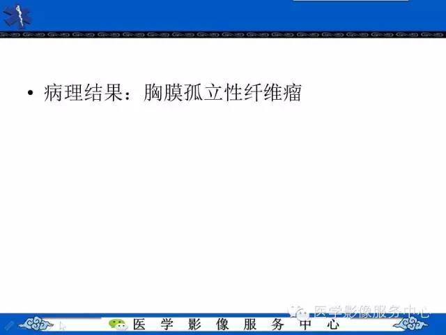 【病例】胸膜孤立性纤维瘤1例CT影像表现与鉴别