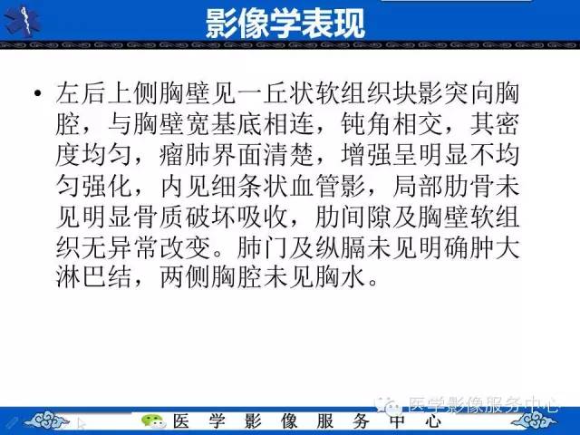 【病例】胸膜孤立性纤维瘤1例CT影像表现与鉴别