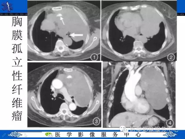 【病例】胸膜孤立性纤维瘤1例CT影像表现与鉴别