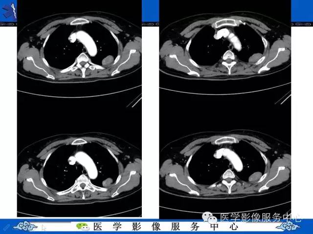 【病例】胸膜孤立性纤维瘤1例CT影像表现与鉴别