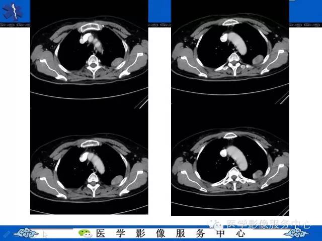 【病例】胸膜孤立性纤维瘤1例CT影像表现与鉴别