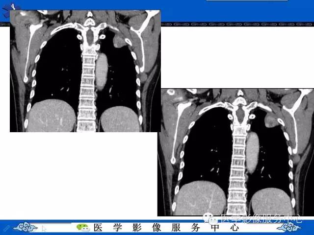 【病例】胸膜孤立性纤维瘤1例CT影像表现与鉴别