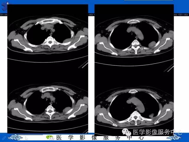 【病例】胸膜孤立性纤维瘤1例CT影像表现与鉴别