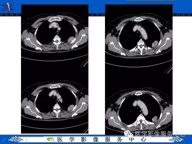 【病例】胸膜孤立性纤维瘤1例CT影像表现与鉴别