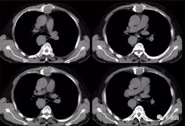 【病例】胸骨浆细胞骨髓瘤1例CT影像表现