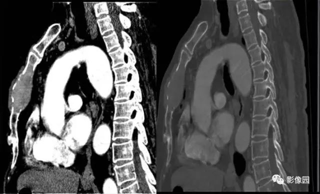 【病例】胸骨浆细胞骨髓瘤1例CT影像表现