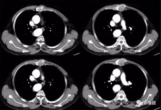 【病例】胸骨浆细胞骨髓瘤1例CT影像表现