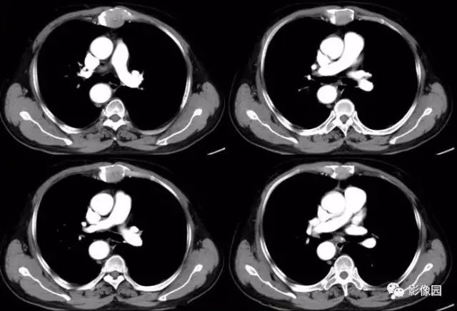 【病例】胸骨浆细胞骨髓瘤1例CT影像表现