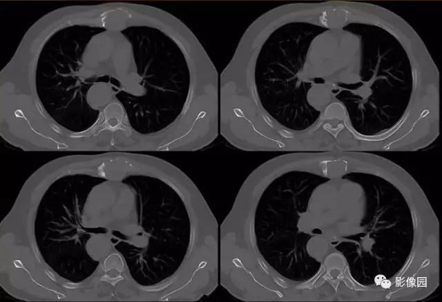 【病例】胸骨浆细胞骨髓瘤1例CT影像表现