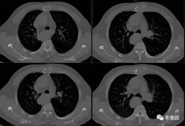 【病例】胸骨浆细胞骨髓瘤1例CT影像表现
