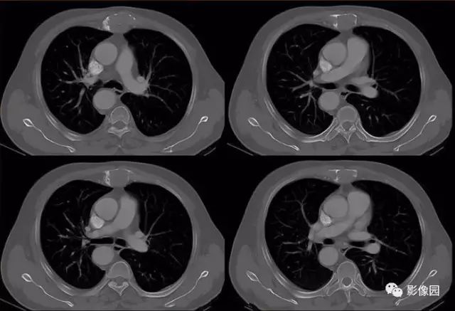 【病例】胸骨浆细胞骨髓瘤1例CT影像表现