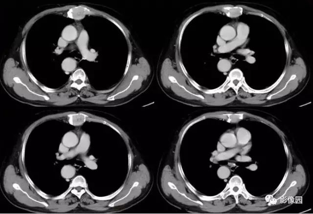 【病例】胸骨浆细胞骨髓瘤1例CT影像表现