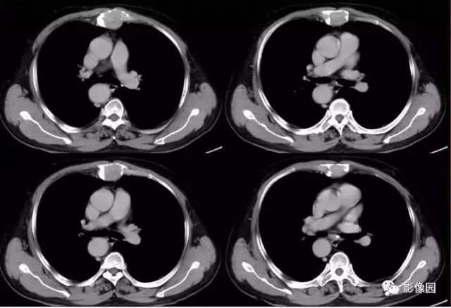 【病例】胸骨浆细胞骨髓瘤1例CT影像表现