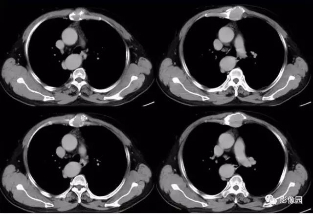 【病例】胸骨浆细胞骨髓瘤1例CT影像表现