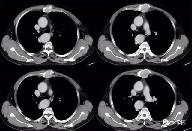 【病例】胸骨浆细胞骨髓瘤1例CT影像表现