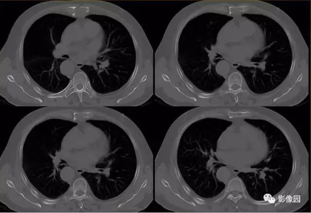 【病例】胸骨浆细胞骨髓瘤1例CT影像表现