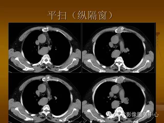 【病例】胸骨浆细胞骨髓瘤1例CT影像表现