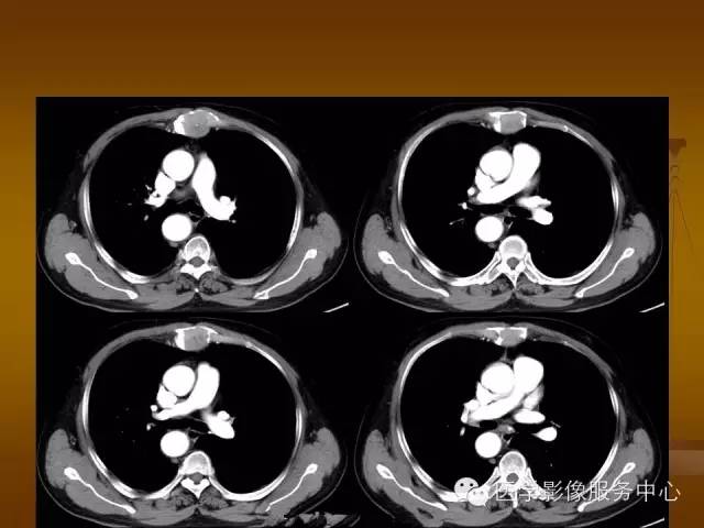 【病例】胸骨浆细胞骨髓瘤1例CT影像表现