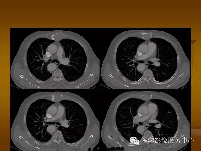【病例】胸骨浆细胞骨髓瘤1例CT影像表现