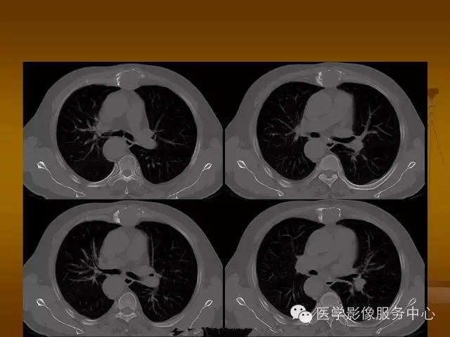 【病例】胸骨浆细胞骨髓瘤1例CT影像表现