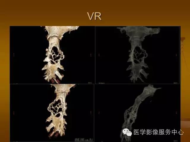 【病例】胸骨浆细胞骨髓瘤1例CT影像表现