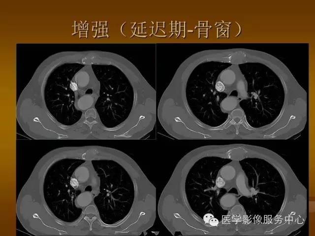 【病例】胸骨浆细胞骨髓瘤1例CT影像表现