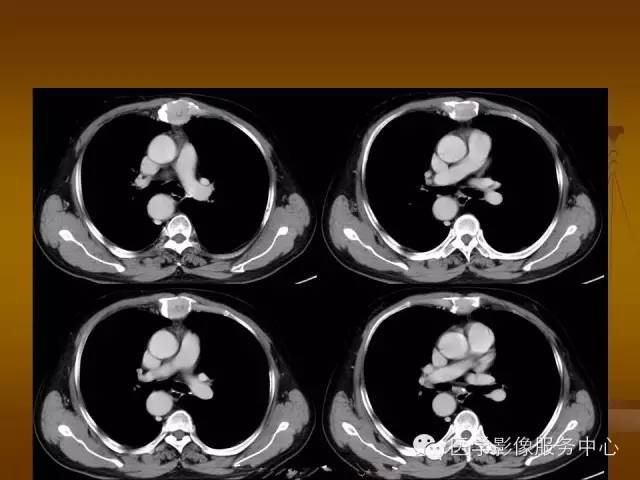 【病例】胸骨浆细胞骨髓瘤1例CT影像表现