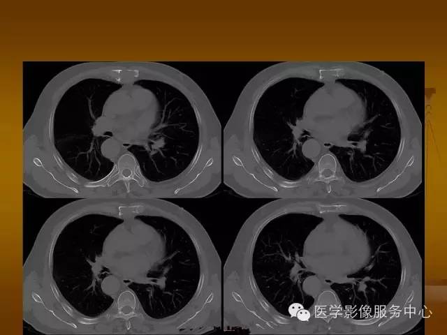 【病例】胸骨浆细胞骨髓瘤1例CT影像表现