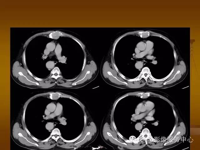 【病例】胸骨浆细胞骨髓瘤1例CT影像表现