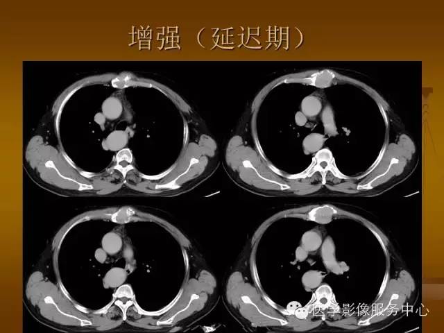 【病例】胸骨浆细胞骨髓瘤1例CT影像表现
